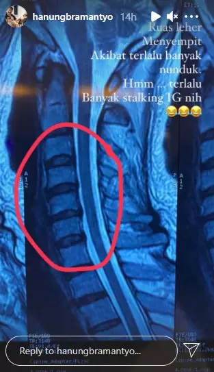Hanung Bramantyo alami ruas leher menyempit © Instagram/@hanungbramantyo
