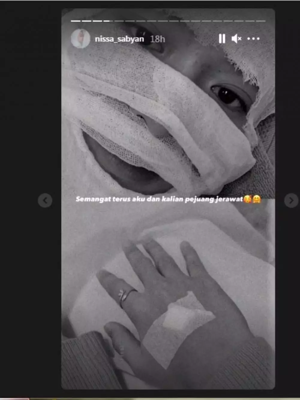 Nissa Sabyan dibalut perban © Instagram