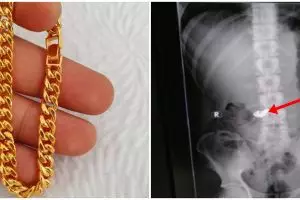 Pencuri di India ini nekat telan potong rantai emas agar tak ketahuan