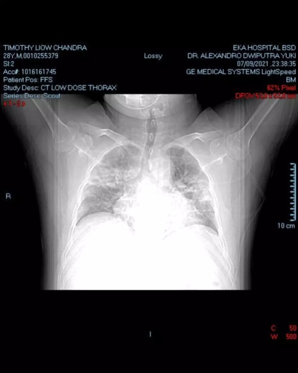 Perjuangan Chandra Liow sembuh dari Covid-19 © Instagram