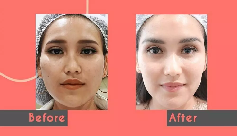 ayu ting ting sebelum dan sesudah perawatan © instagram