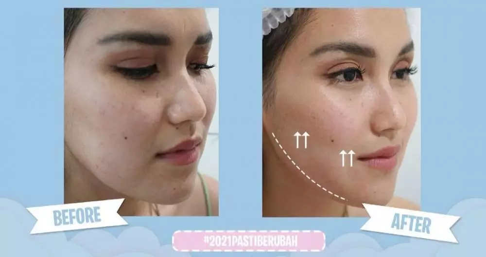 ayu ting ting sebelum dan sesudah perawatan © instagram