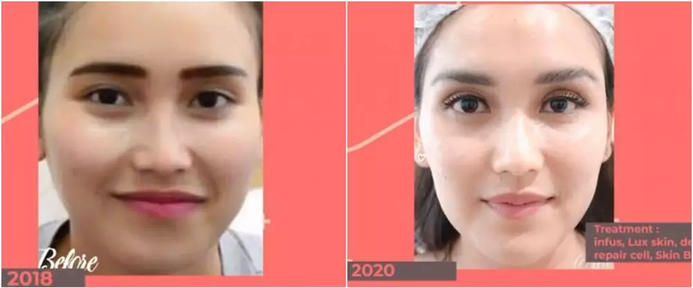 ayu ting ting sebelum dan sesudah perawatan © instagram