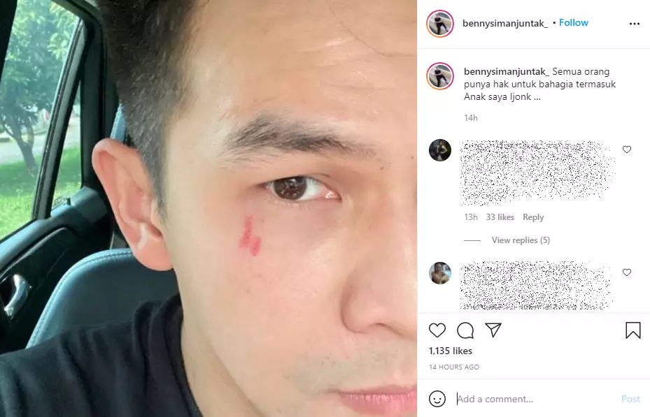Benny Simanjuntak unggah potret Jonathan Frizzy dengan luka cakar Instagram Benny Simanjuntak unggah potret Jonathan Frizzy dengan luka cakar Instagram