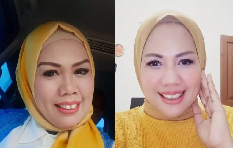 Elly Sugigi sebelum dan sesudah perawatan dari berbagai sumber