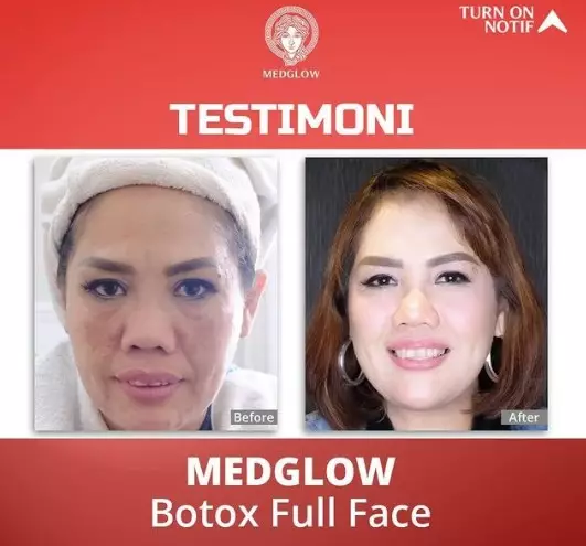 Elly Sugigi sebelum dan sesudah perawatan dari berbagai sumber