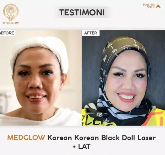 Elly Sugigi sebelum dan sesudah perawatan dari berbagai sumber