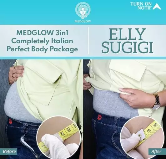 Elly Sugigi sebelum dan sesudah perawatan dari berbagai sumber