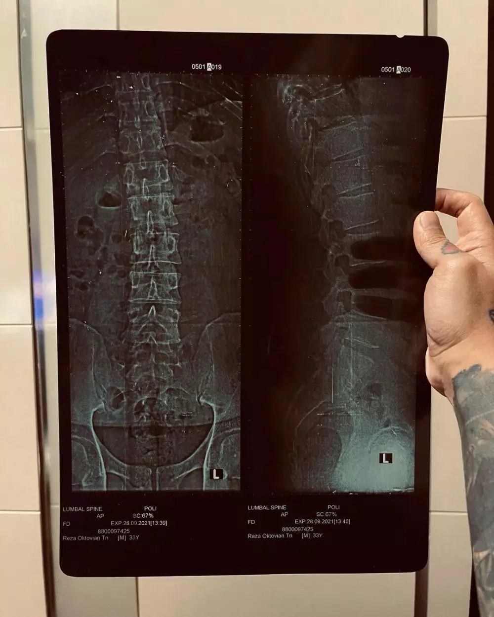 reza arap depresi alami pergeseran tulang © instagram reza arap depresi alami pergeseran tulang © instagram