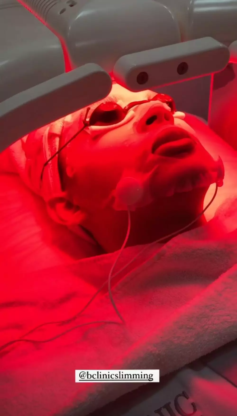 Perawatan Rey Mbayang © 2021 brilio.net