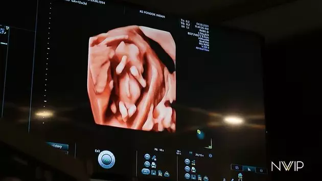 Nikita willy jalani usg © 2021 YouTube