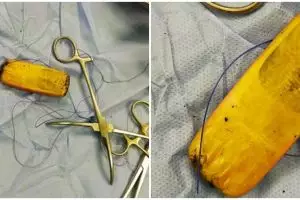 Dokter temukan ponsel Nokia 3310 di perut pasien, tertelan 6 bulan