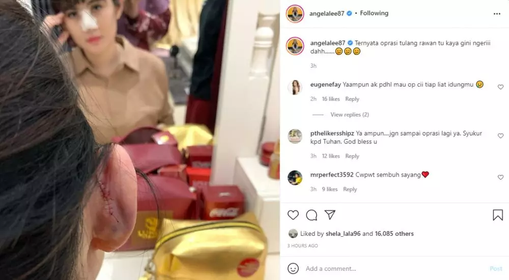 Kondisi Angela Lee usai operasi hidung Instagram Kondisi Angela Lee usai operasi hidung Instagram