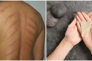 4 Alat kerokan unik dari bahan tak biasa, masuk angin langsung ngacir