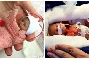 Bayi terkecil di dunia kini beranjak remaja, begini potret terbarunya