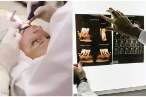 Berawal dari veneer gigi, wajah wanita ini berakhir lumpuh sebelah