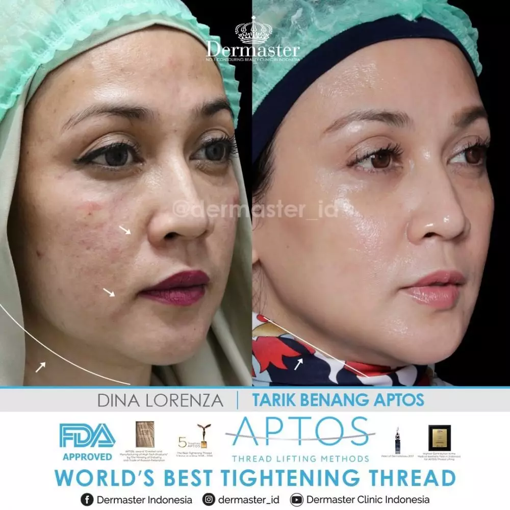 Potret Dina Lorenza usai perawatan tanam benang © Instagram Potret Dina Lorenza usai perawatan tanam benang © Instagram