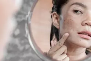 Kenali 4 jenis flek wajah dan cara mengatasinya, kulit auto glowing  