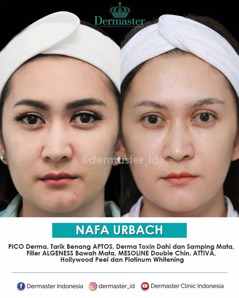 seleb 40-an sebelum dan sesudah tanam benang © berbagai sumber seleb 40-an sebelum dan sesudah tanam benang © berbagai sumber