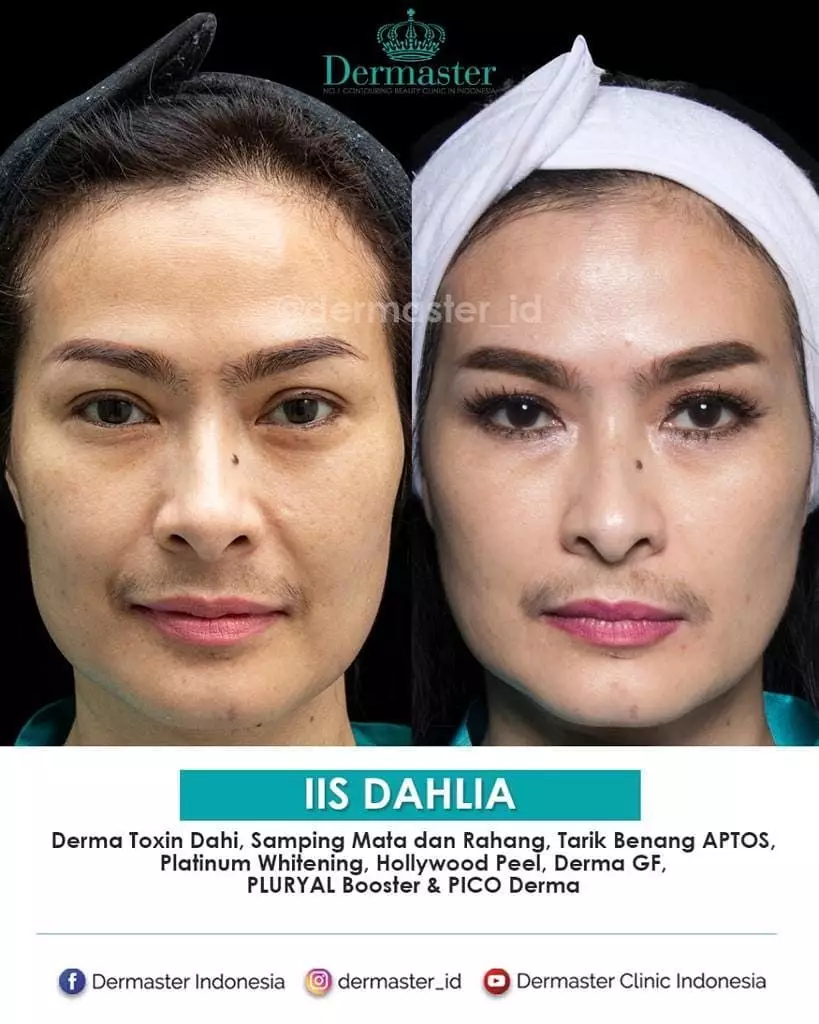 seleb 40-an sebelum dan sesudah tanam benang © berbagai sumber seleb 40-an sebelum dan sesudah tanam benang © berbagai sumber
