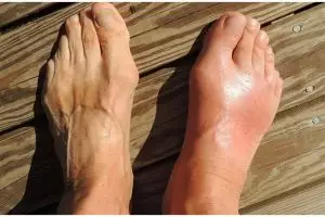 Trik memasak untuk penderita asam urat, sehat dan mudah ditiru