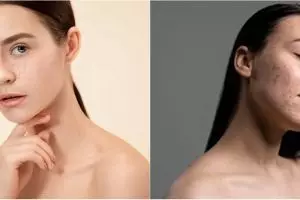 11 Rekomendasi skincare menghilangkan flek hitam & cara menggunakannya