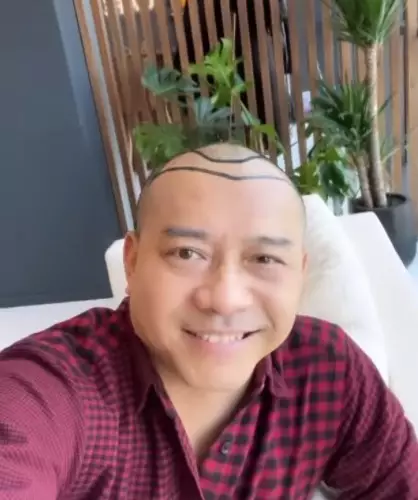 Potret Anang Hermansyah tampil botak © berbagai sumber