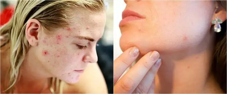 9 Cara menghilangkan bekas luka di wajah, aman dan mudah dibuat