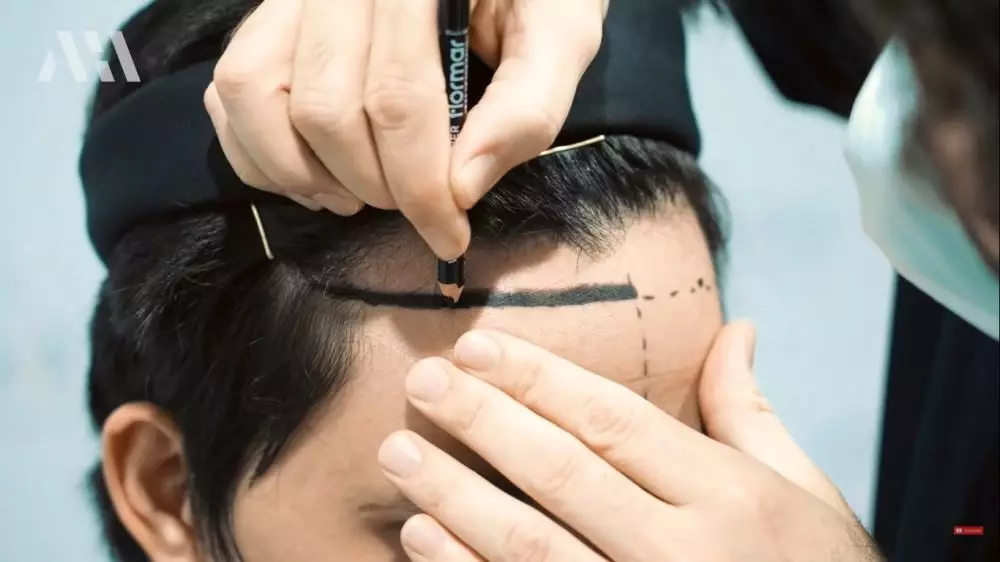 Tak pede berjidat lebar, 9 potret Atta Halilintar transplantasi rambut berbagai sumber