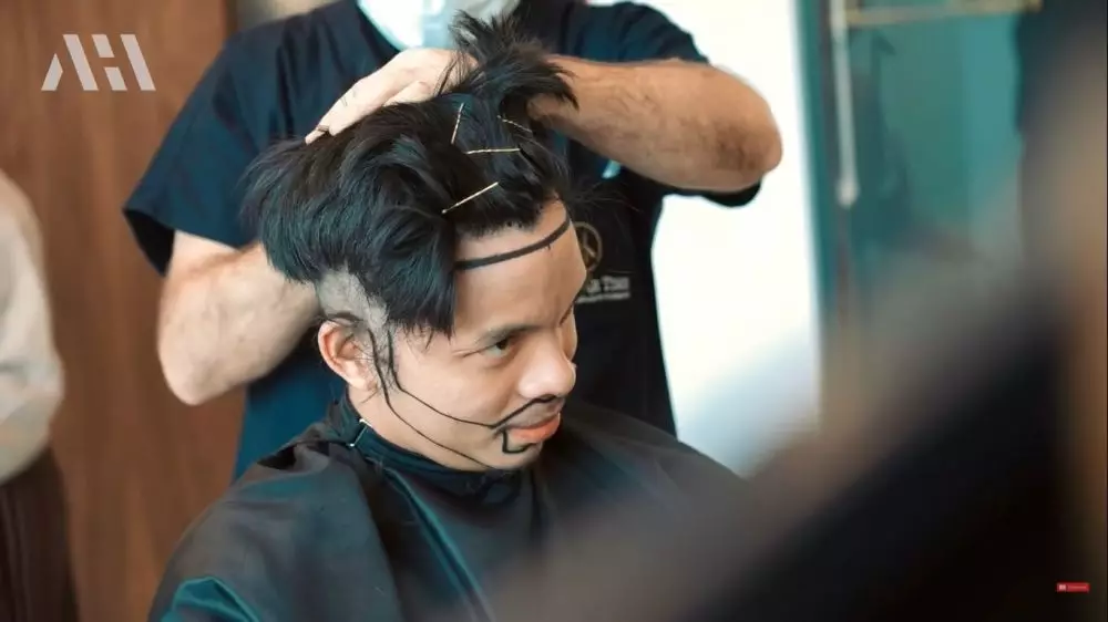 Tak pede berjidat lebar, 9 potret Atta Halilintar transplantasi rambut berbagai sumber