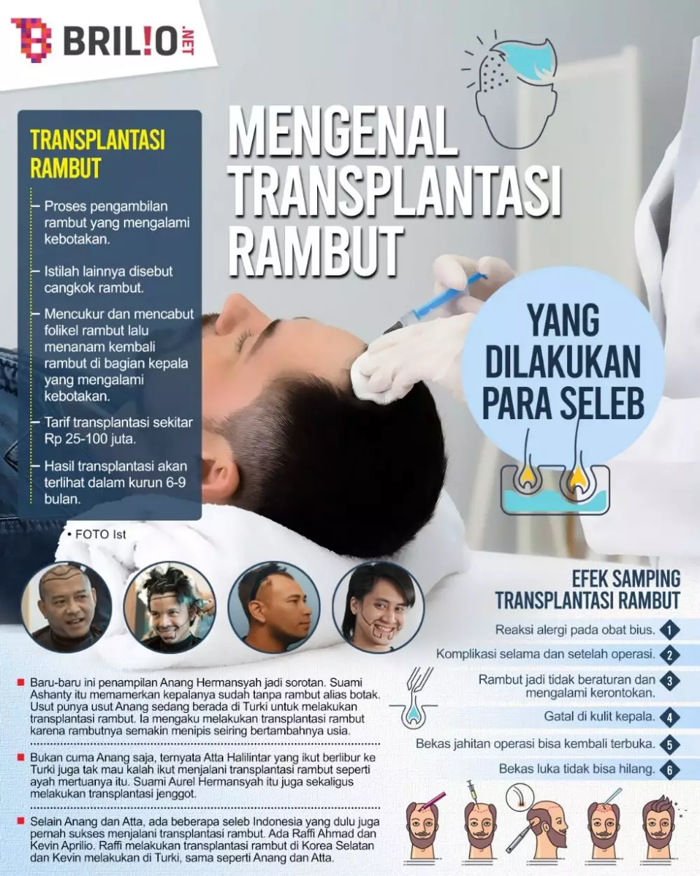 INFOGRAFIK TRANSPLANTASI RAMBUT © 2022 brilio.net