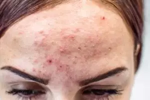 14 Rekomendasi serum hempas beruntusan mulai harga Rp 20 ribu, wajah halus tanpa treatment klinik