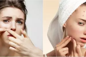 9 Rekomendasi skincare penghilang jerawat, mulus tanpa bekas