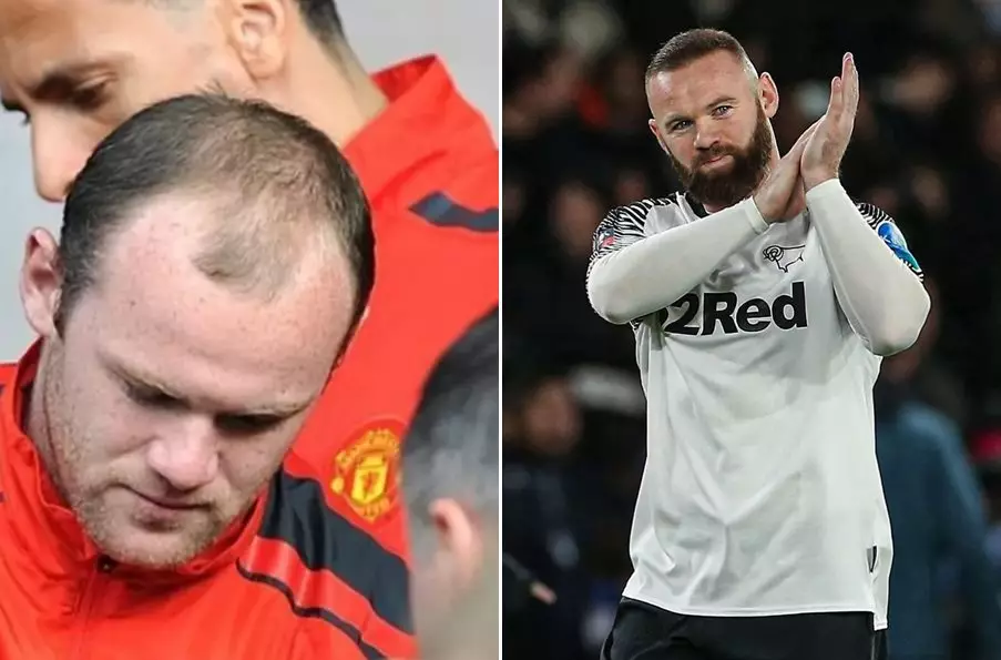 seleb usai transplantasi rambut Berbagai sumber