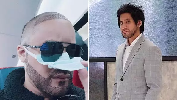 seleb usai transplantasi rambut Berbagai sumber