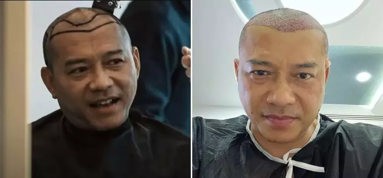 seleb usai transplantasi rambut Berbagai sumber