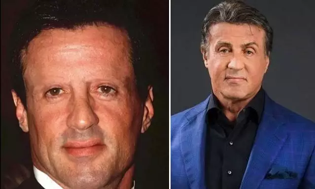 seleb usai transplantasi rambut Berbagai sumber