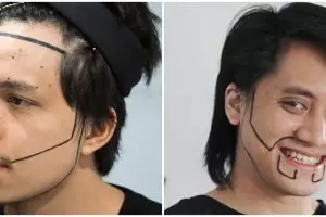 Penampilan 6 seleb usai transplantasi rambut, Atta Halilintar makin PD