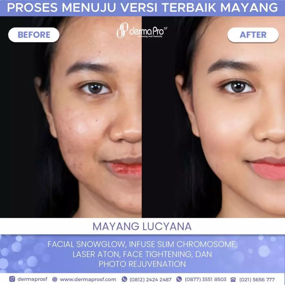 Mayang sebelum dan sesudah perawatan wajah  Berbagai sumber