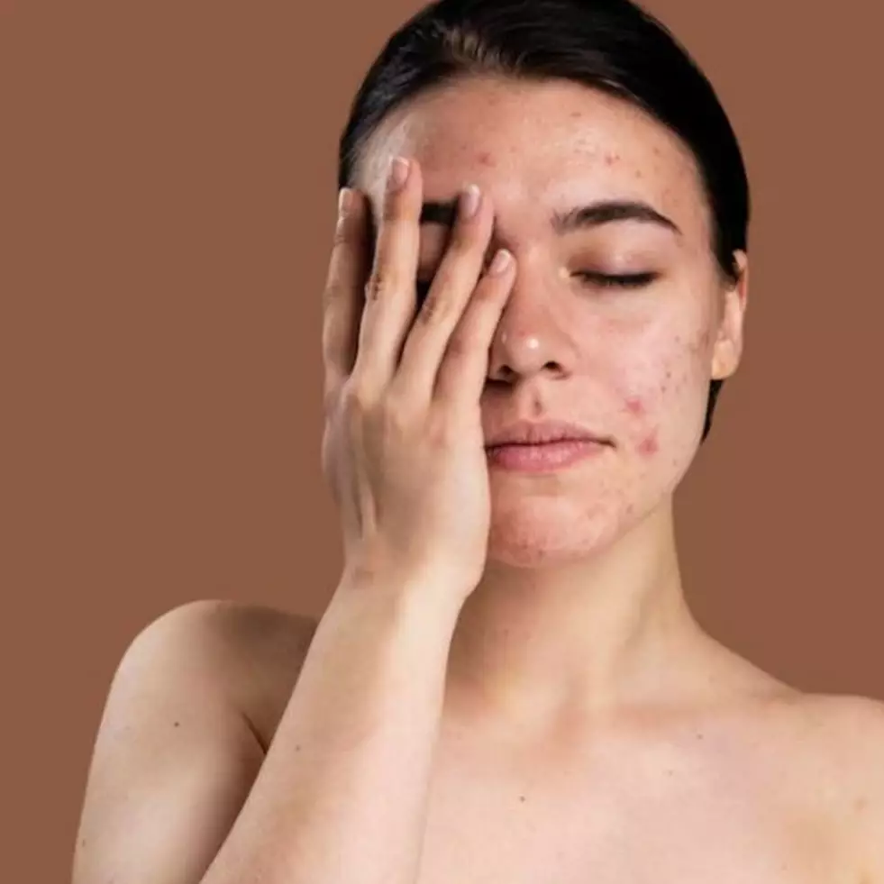 7 Rekomendasi serum untuk kulit berjerawat, bikin kulit jadi mulus