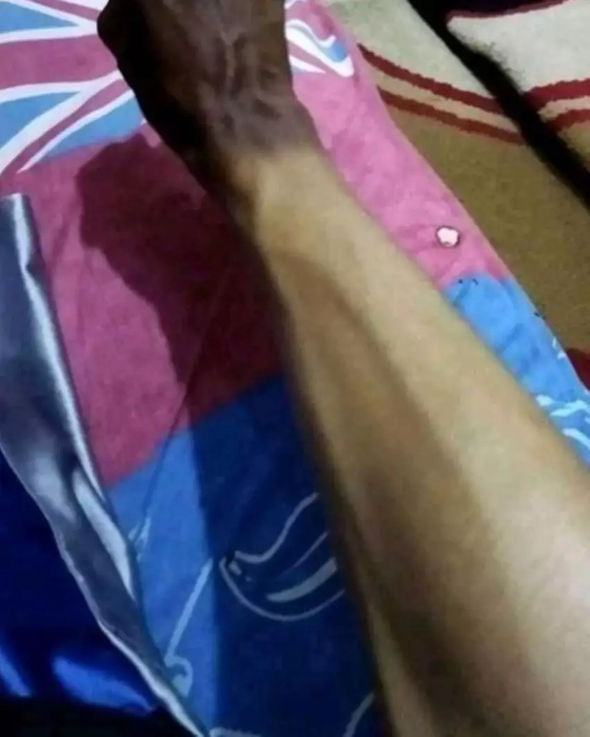 akibat terkena sinar matahari © berbagai sumber