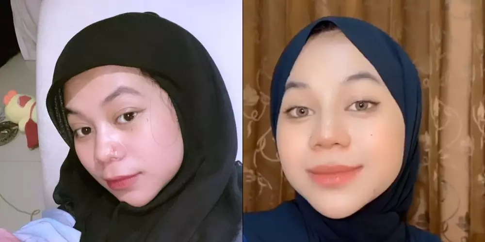 potret dulu dan kini cimoy montok setelah filler hidung © berbagai sumber