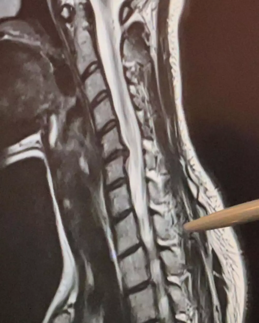 Sheryl Sheinafia ceritakan kronologi alami saraf kejepit Instagram Sheryl Sheinafia ceritakan kronologi alami saraf kejepit Instagram