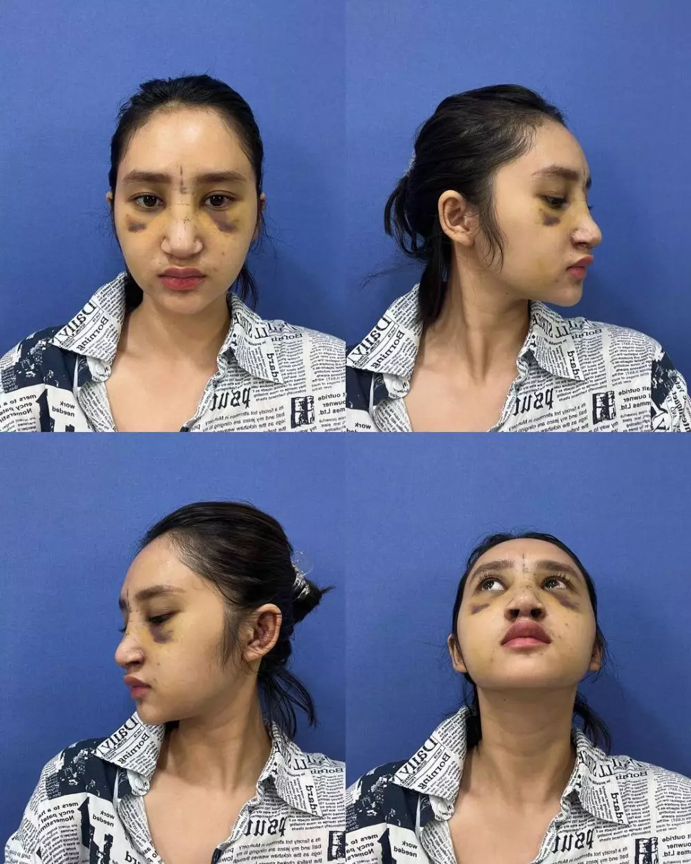 putri Farida Nurhan setelah oplas © Instagram