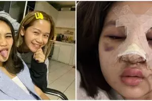 Alami efek samping usai oplas, ini 9 foto terbaru putri Farida Nurhan
