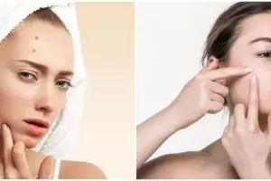 9 Kandungan skincare untuk kulit berjerawat, wajib dicoba