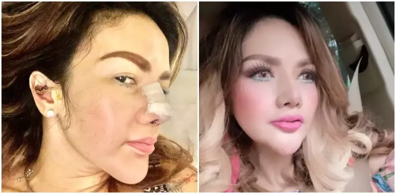 penampilan seleb usai operasi hidung Berbagai sumber
