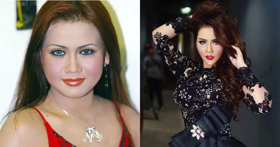 penampilan seleb usai operasi hidung Berbagai sumber