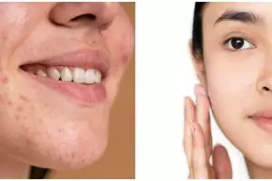 8 Manfaat acne serum Somethinc, basmi jerawat membandel