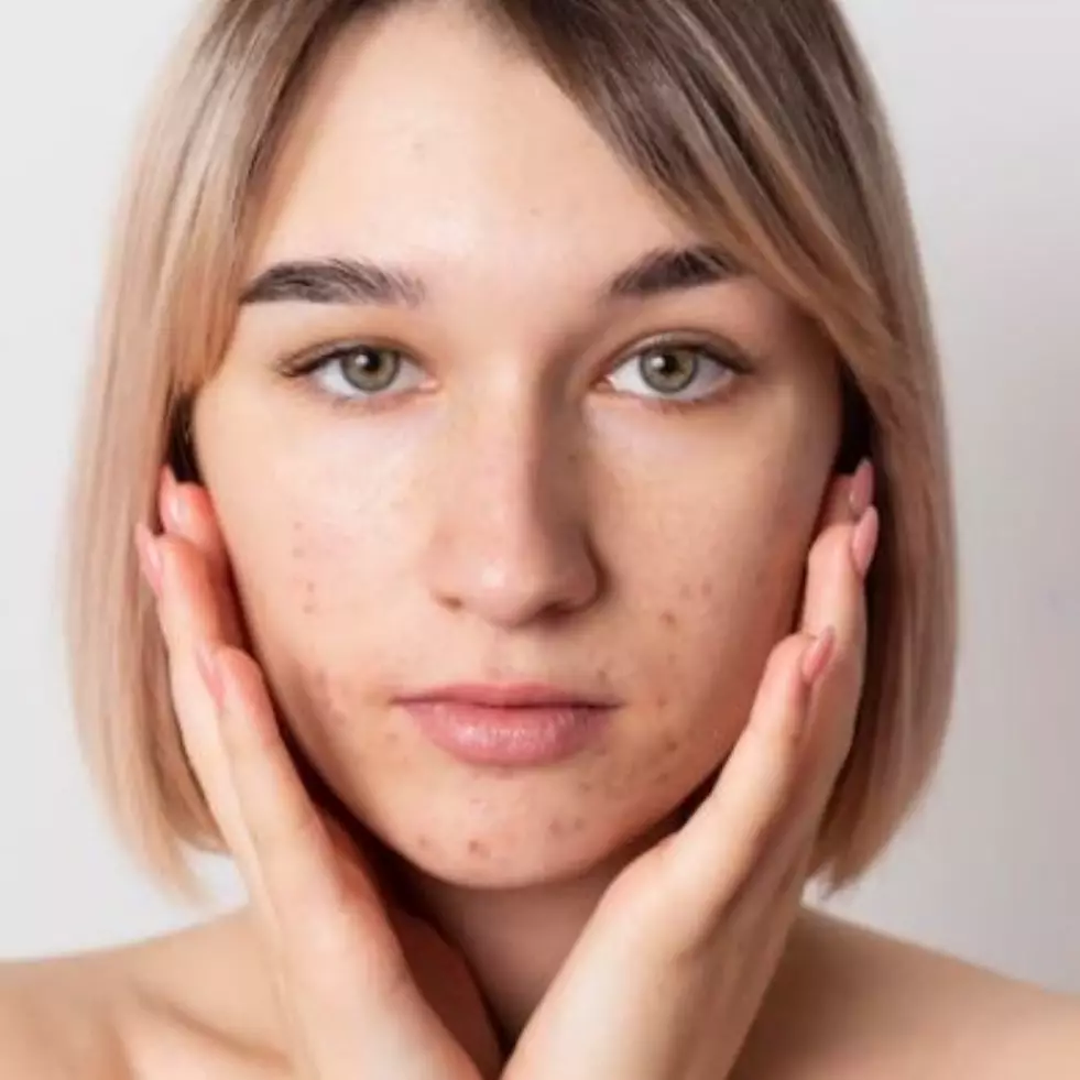 Mengenal milia pada wajah dan 7 cara mengatasinya